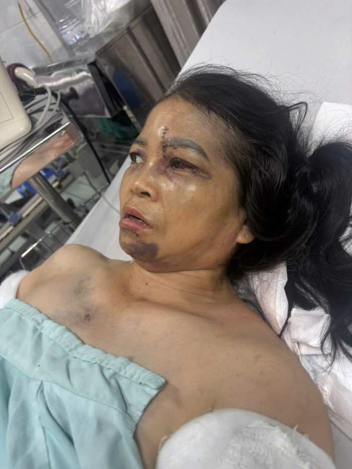 Chị Thắm không may bị ngã từ tầng 2 xuống đất, gây đa chấn thương nghiêm trọng. Ảnh: Gia đình cung cấp