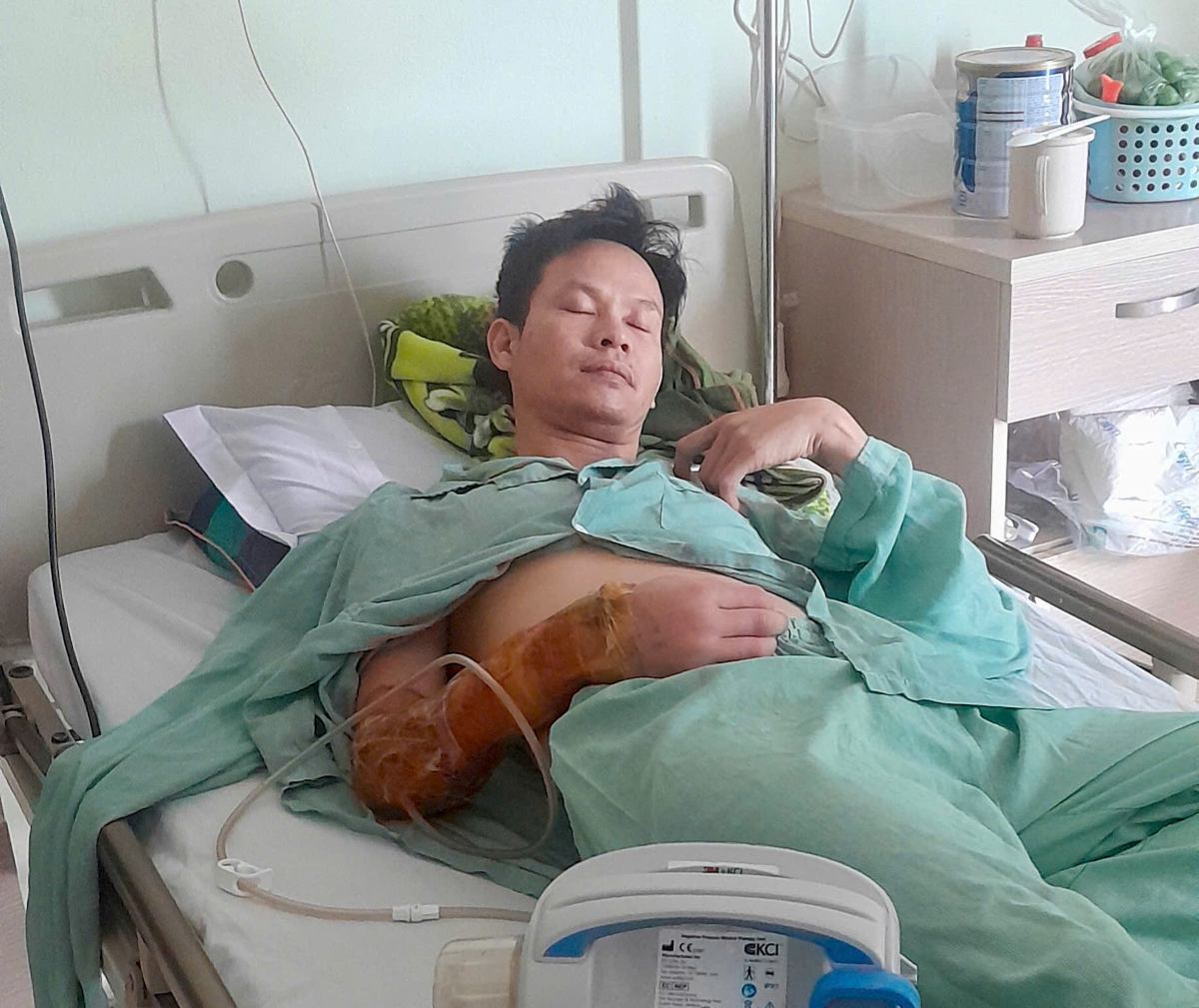 LD26186: Nam công nhân Hải Phòng bị dập cánh tay phải, mất khả năng lao động