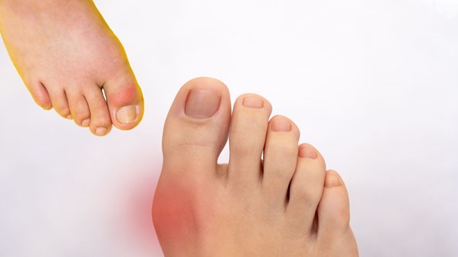 Tăng axit uric máu và bệnh gout có mối liên quan mật thiết với chế độ ăn uống và lối sống. Ảnh có sử dụng AI: Hương Sơn